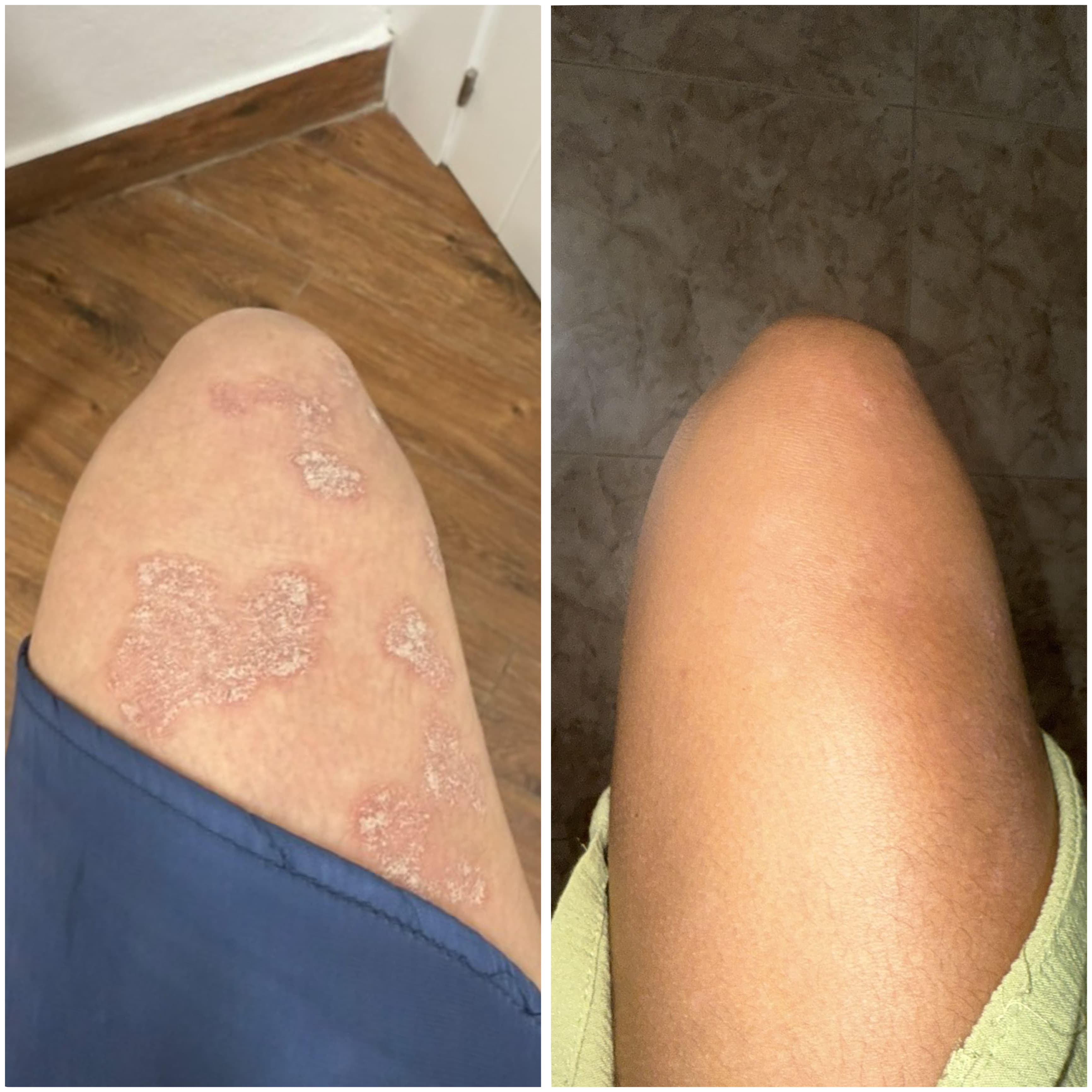 Cremă reparatoare cu CBD pentru piele uscată, descuamată și cu tendință psoriazică.