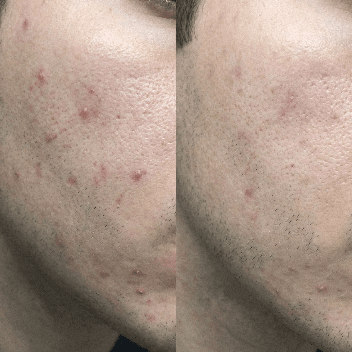 Cremă CBD purificatoare pentru tenul cu tendință acneică