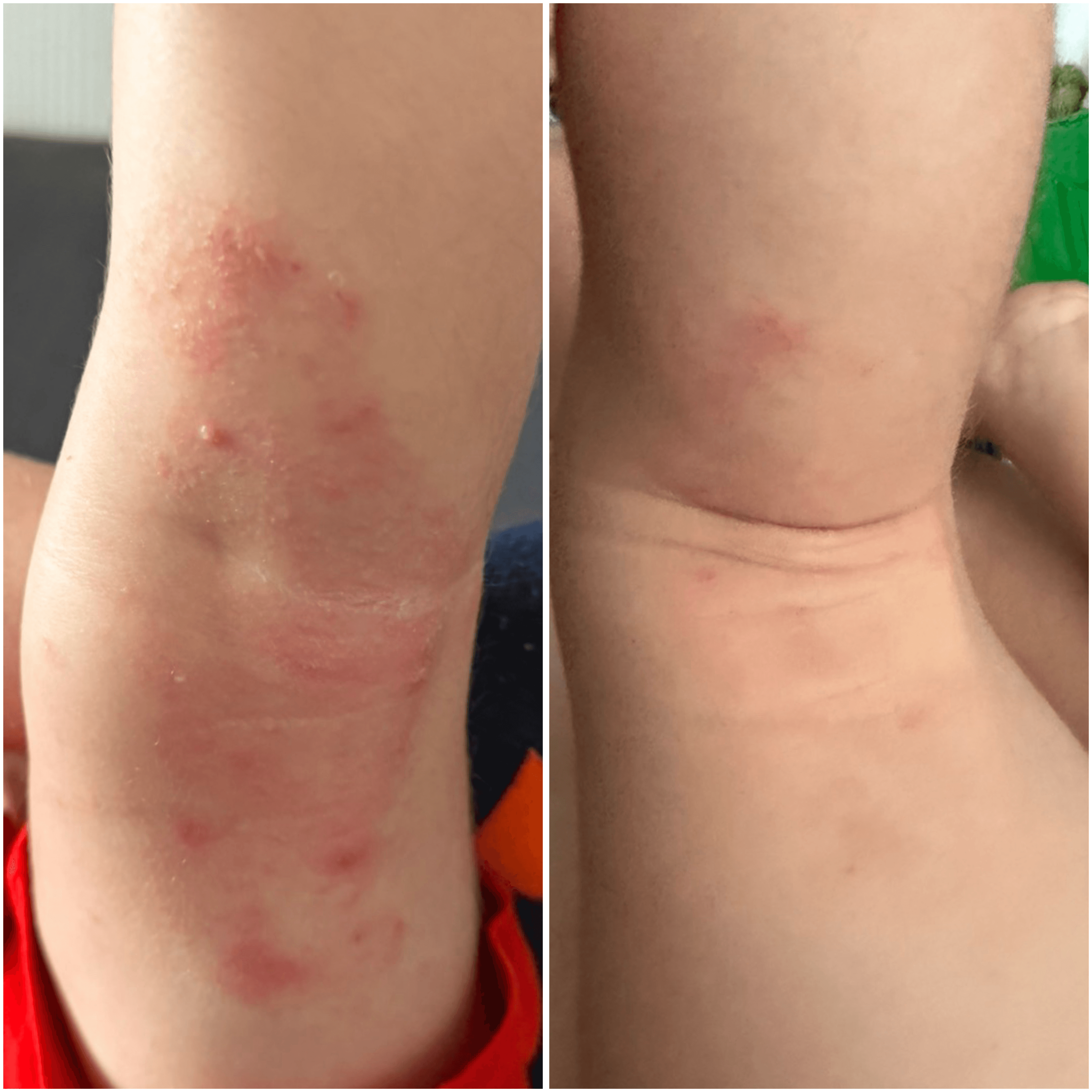 Cremă cu CBD pentru piele uscată, atopică și predispusă la eczeme