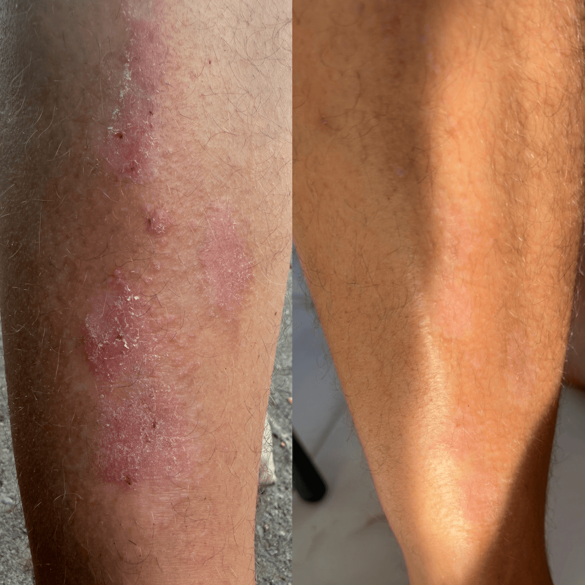Cremă reparatoare cu CBD pentru piele uscată, descuamată și cu tendință psoriazică.